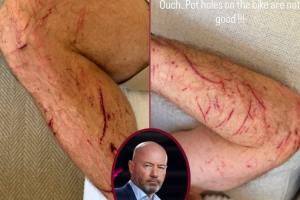 55岁希勒骑自行车时受伤：手臂、腿部多处割伤和擦伤